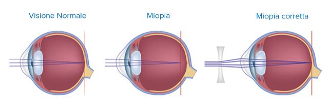 miopia hipermetropia astigmatismo miopie mare complicată ce este